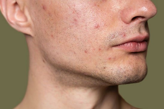 chemical peel treatment in bangalore banashankari